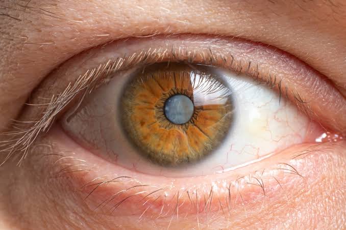 Common Questions Patients Ask Before Eye Cataract Surgery