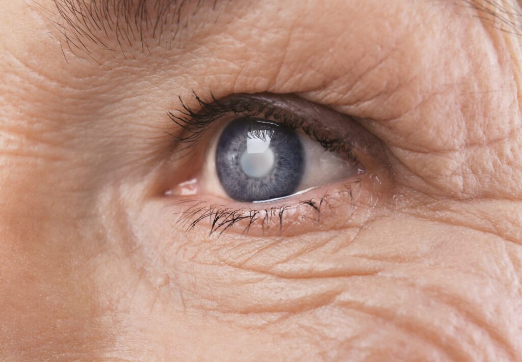 Common Questions Patients Ask Before Eye Cataract Surgery

